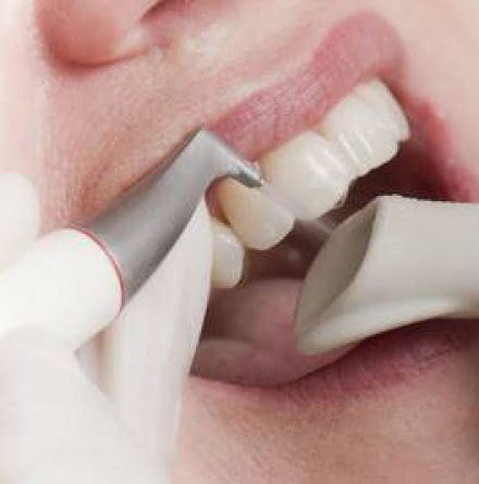 Tooth Airpolishing Treatment