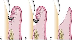 Gingival Curettage Treatment