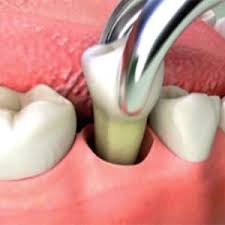 Routine Tooth Extraction