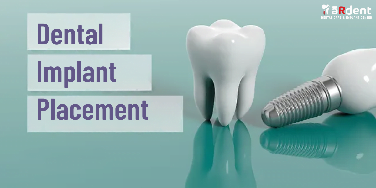 Dental Implant procedure, best dental implants, tooth replacement solution, advanced dental care, implant dentistry benefits