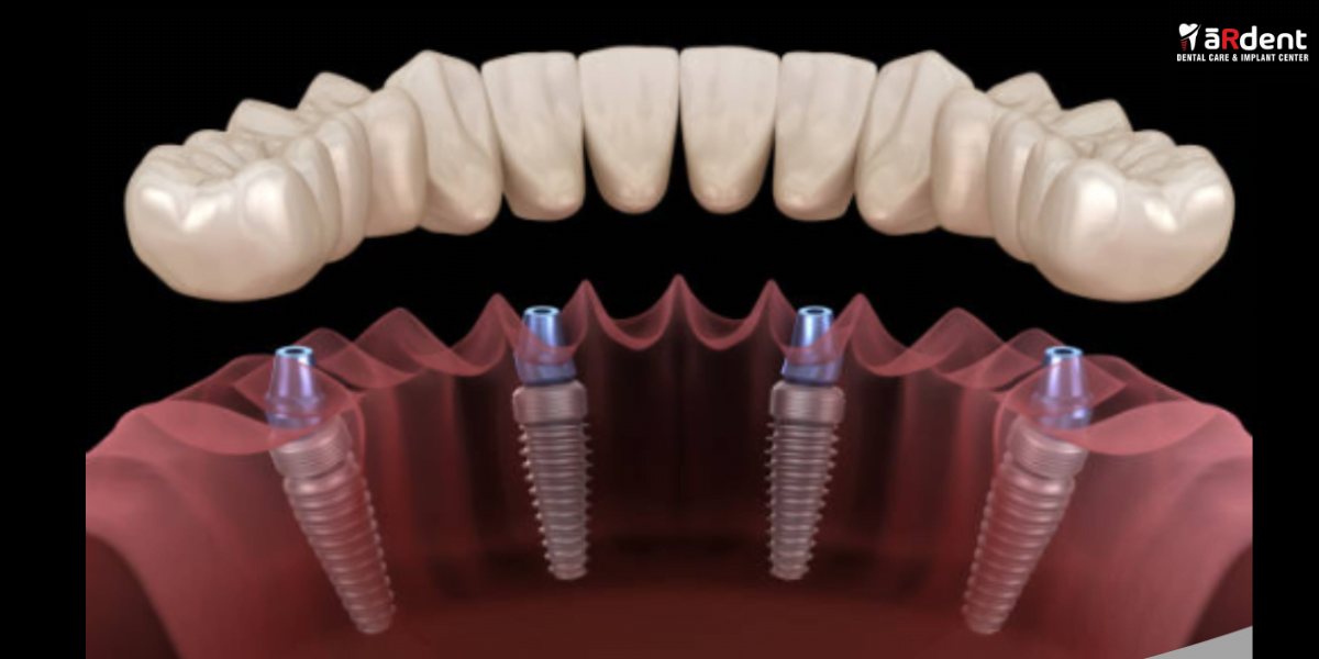 Dental implant smile transformation close-up, dentist office, implant procedure, oral health care, tooth replacement